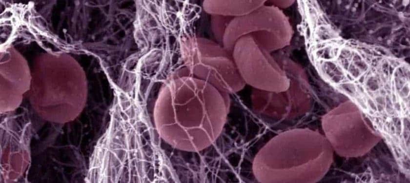 Blood clot - Wellcome images blood clot