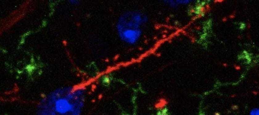 143141_web IN THE BRAIN, A SYNAPSE (ORANGE) IS SEEN BEING WRAPPED AROUND AND ATTACKED BY IMMUNE CELLS CALLED MICROGLIA (GREEN), LEADING TO SYNAPSE LOSS.