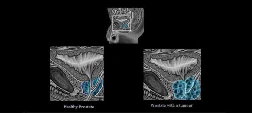 Prostate_Cancer-3-1050-x469 black bgd Prostate_Cancer-3-1050-x469 black bgd