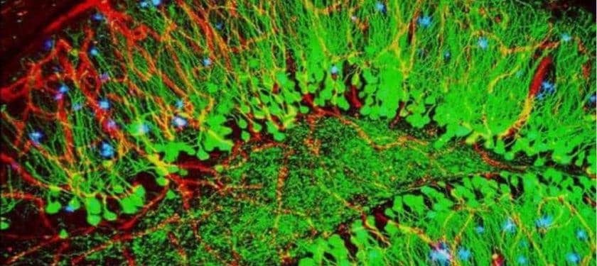 crop_24- NIH Brain showing hallmarks of Alzheimer’s disease (plaques in blue)