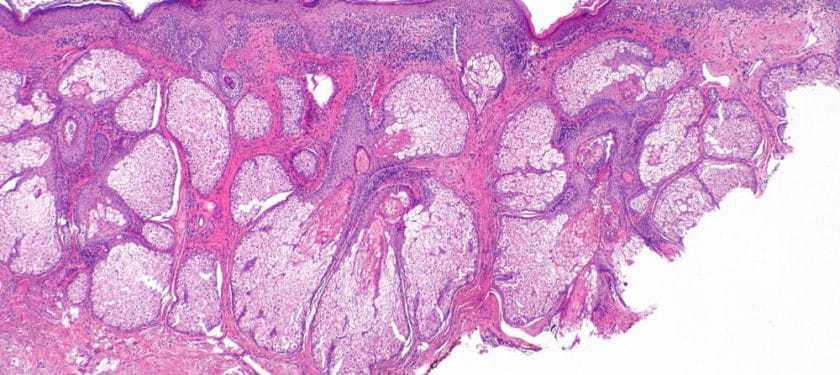 1000pxMalignant melanoma in situ CC BY-SA 3 Nephron 1000pxMalignant melanoma in situ CC BY-SA 3 Nephron