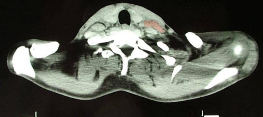1024px-Hodgkin_Lymphoma_CT2 1024px-Hodgkin_Lymphoma_CT2
