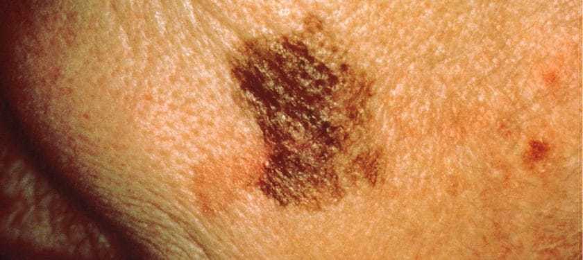 1067px-Melanoma_with_diameter_change CC0 NCI 1067px-Melanoma_with_diameter_change CC0 NCI