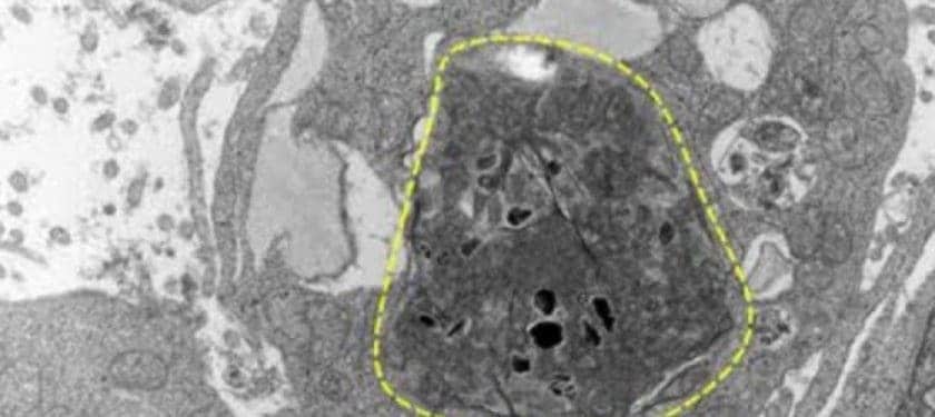 160667_web melanoma cell injested by immune cell 160667_web melanoma cell injested by immune cell