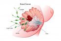 Breast cancer can form 'sleeper cells' after drug treatment