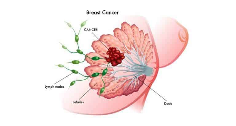Breast cancer can form ‘sleeper cells’ after drug treatment