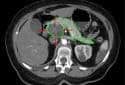 MBq_cystic-carcinoma-pancreas_segmentiert Public domain