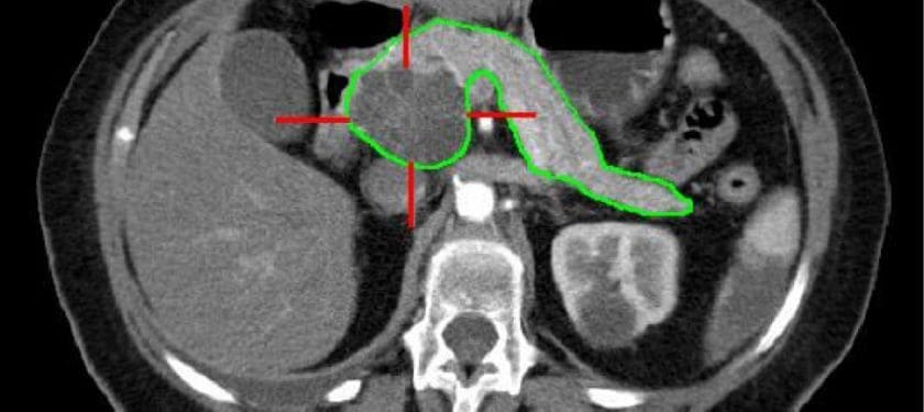 MBq_cystic-carcinoma-pancreas_segmentiert Public domain CT scan, pancreatic cancer