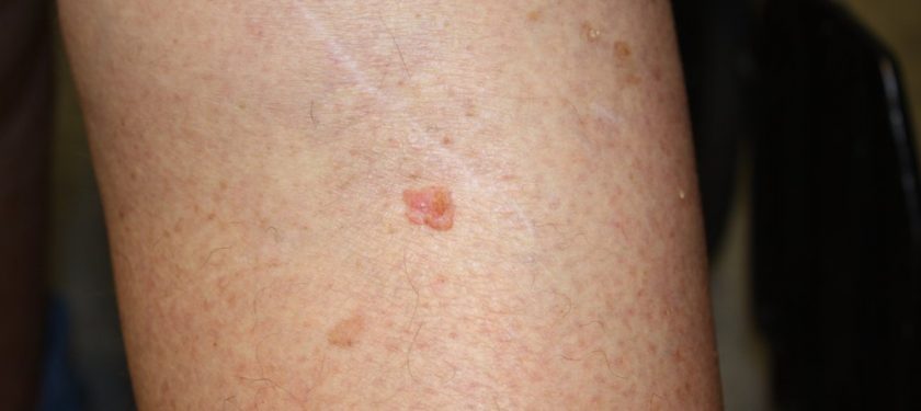 Squamous_cell_carcinoma -NCI Squamous_cell_carcinoma -NCI