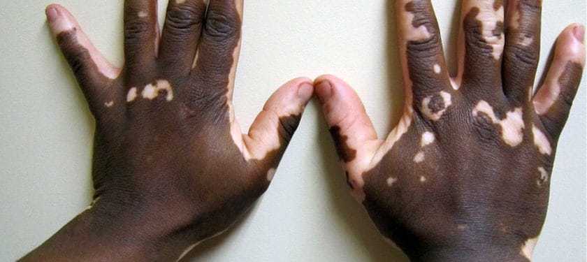 Vitiligo2 CC BY-SA 3.0 - James Heilman, MD Vitiligo2 CC BY-SA 3.0 - James Heilman, MD