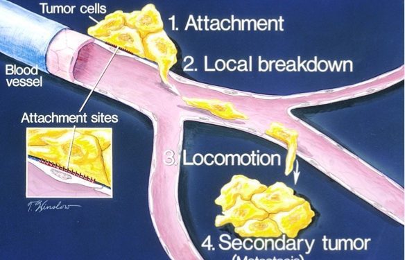 1000px-How_metastasis_occurs_illustration-public domain NCI 1000px-How_metastasis_occurs_illustration-public domain NCI