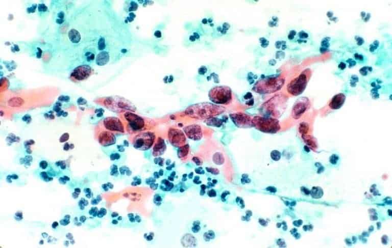 Cutting off cervical cancer’s fuel supply stymies tumors