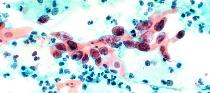 1200px-Cytological_specimen_showing_cervical_cancer NCI 1200px-Cytological_specimen_showing_cervical_cancer NCI