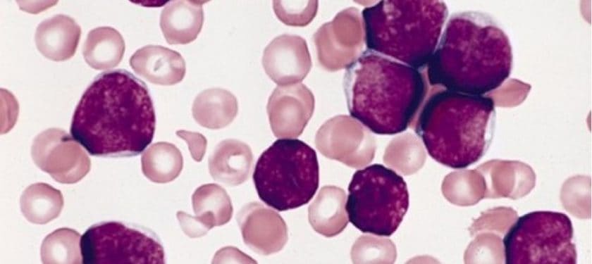 335px-ALL-L1 Public Domain - The Armed Forces Institute of Pathology (AFIP) 335px-ALL-L1 Public Domain - The Armed Forces Institute of Pathology (AFIP)