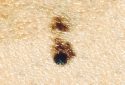A new approach to predicting melanoma treatment outcomes