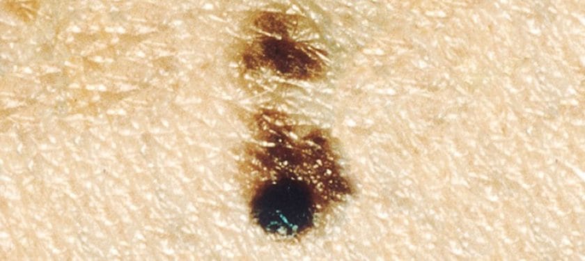 755px-Melanoma_1000px Public Domain NCI 755px-Melanoma_1000px Public Domain NCI