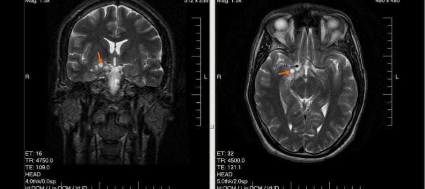 1200px-MRI_glioma_28_yr_old_male 1200px-MRI_glioma_28_yr_old_male