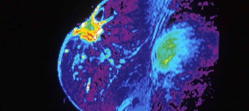 1200px-Mri_of_breast 1200px-Mri_of_breast