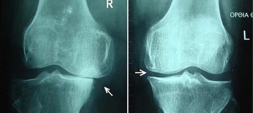 640px-Knee_osteoathritis_stages_II_nad_III Osteoarthritis