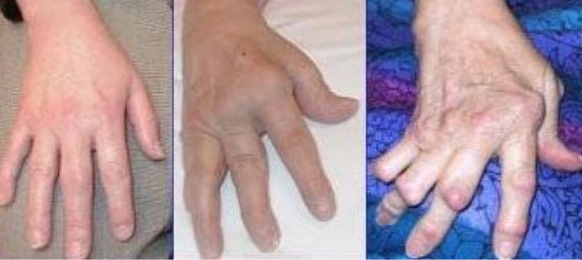 Arthrite_rhumatoide Arthrite_rhumatoide