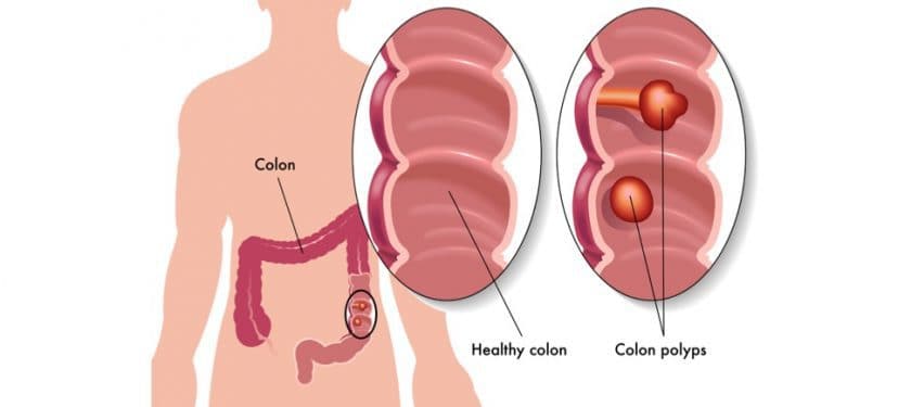 Depositphotos_60338371_m-2015-rob3000 colon polyps