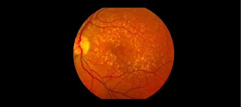 Intermediate_age_related_macular_degeneration Intermediate_age_related_macular_degeneration