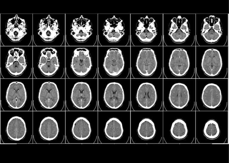 Study confirms link between traumatic brain injury and dementia
