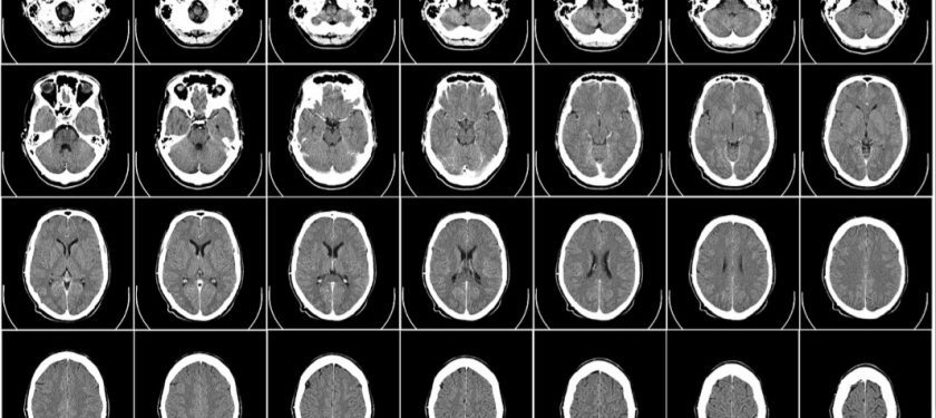 computer-tomography-62942_1280 computer-tomography-62942_1280