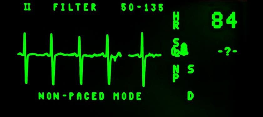 electrocardiogram-16948_1280 electrocardiogram-16948_1280