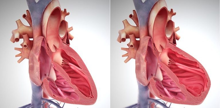1200px-Right_side_heart_failure cardiomyopathy, heart failure