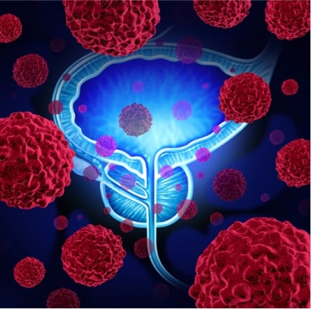 Discovery shows how difficult-to-treat prostate cancer evades immune system