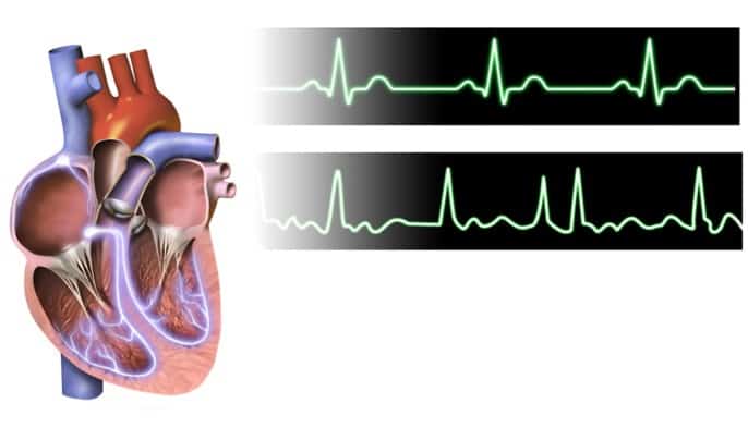 People with atrial fibrillation live longer with exercise
