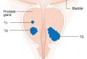 Testosterone slows prostate cancer recurrence in low-risk patients