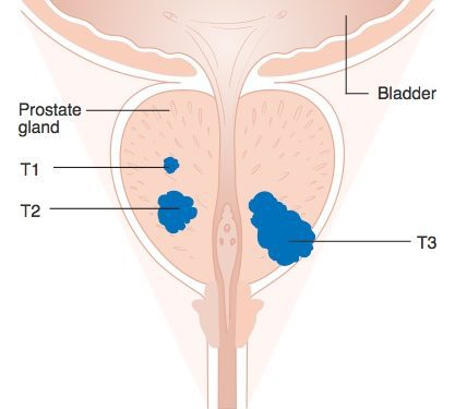 Diagram_showing_T1-3_stages_of_prostate_cancer_CRUK_278 prostate cancer