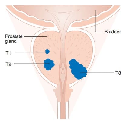 Study paves the way for better treatment of prostate cancer