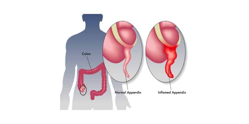 Research shows benefits/risks of treating appendicitis with antibiotics instead of surgery
