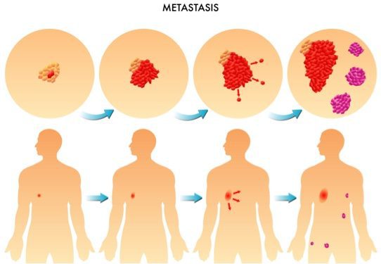 Depositphotos_73928443_m-2015-rob3000 metastasis