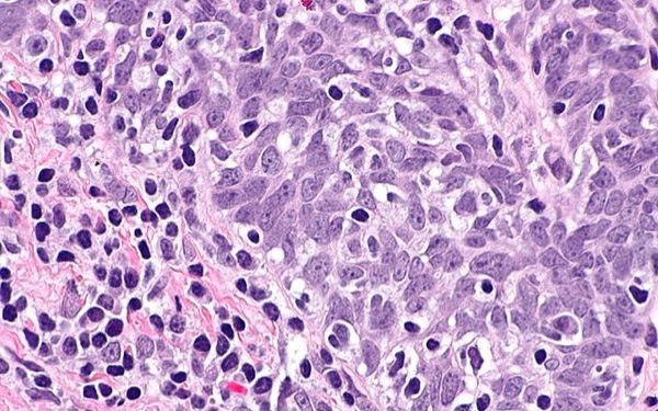 640px-Squamous_cell_carcinoma_-_p16_positive_--_very_high_mag 640px-Squamous_cell_carcinoma_-_p16_positive_--_very_high_mag