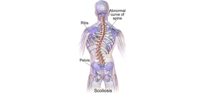 240px-Blausen_0785_Scoliosis_01 240px-Blausen_0785_Scoliosis_01