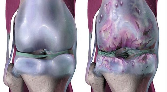 523px-Osteoarthritis Osteoarthritis