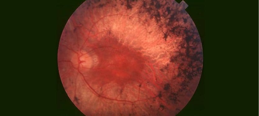 560px-Fundus_of_patient_with_retinitis_pigmentosa,_mid_stage