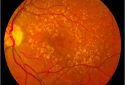 International team delivers research breakthrough for leading cause of blindness