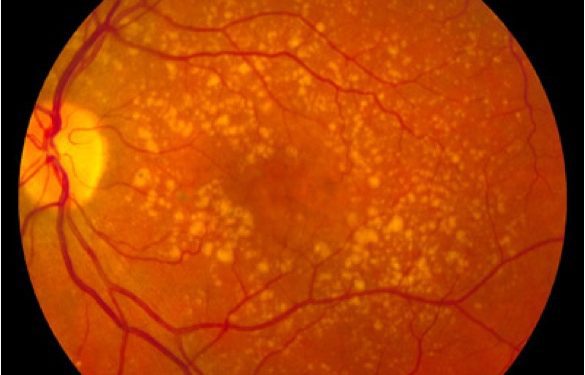 Intermediate_age_related_macular_degeneration age-related macular degeneration, AMD