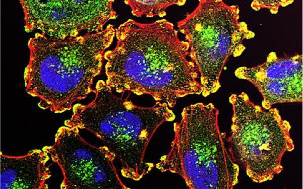 480px-Metastatic_Melanoma_Cells_Nci-vol-9872-300 480px-Metastatic_Melanoma_Cells_Nci-vol-9872-300