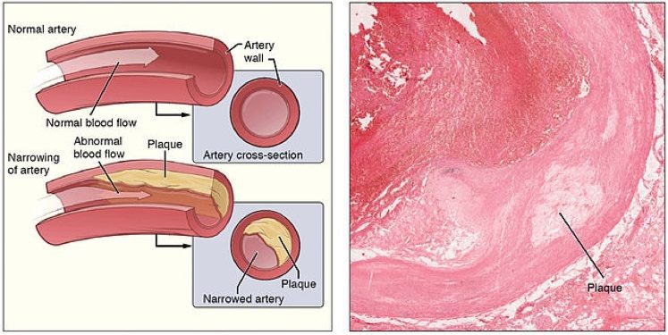 640px-2113ab_Atherosclerosis Atherosclerosis, artery plaque