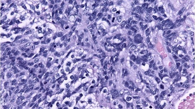 640px-Anaplastic_medulloblastoma_x200 640px-Anaplastic_medulloblastoma_x200