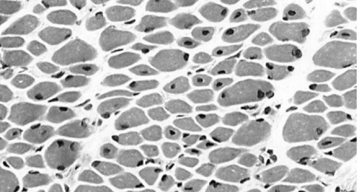 640px-Centronuclear_myotubular_myopathy 640px-Centronuclear_myotubular_myopathy
