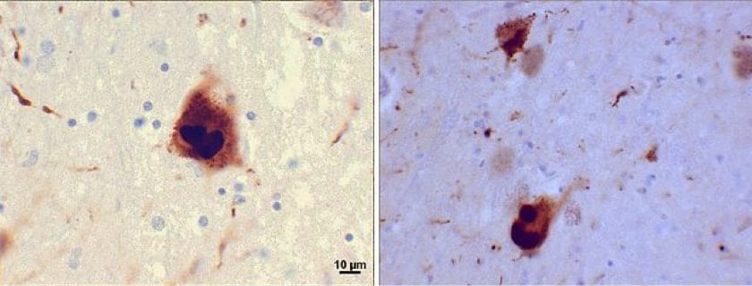 640px-Lewy_bodies_(alpha_synuclein_inclusions) Parkinson's disease, Lewy bodies, alpha-synuclein