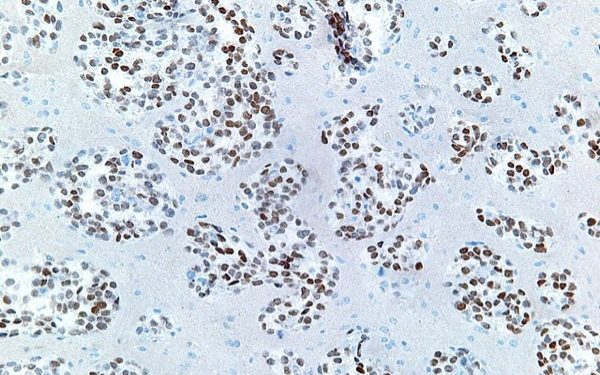 640px-Lung_adenocarcinoma_-_TTF-1_-_high_mag 640px-Lung_adenocarcinoma_-_TTF-1_-_high_mag