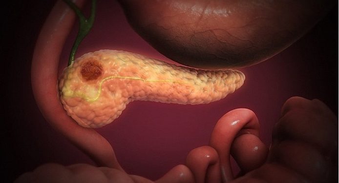 640px-Pancreatic_Cancer pancreatic cancer
